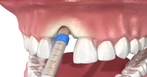 Dental Bone Graft