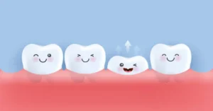 Dental Veneers for Missing Teeth
