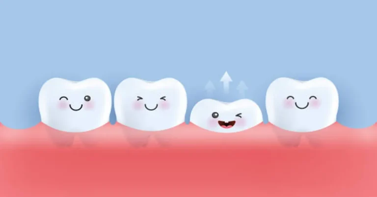 Dental Veneers for Missing Teeth