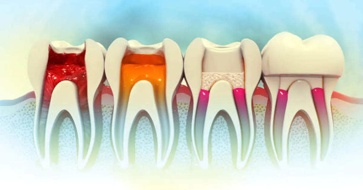 How Long Does a Root Canal Take